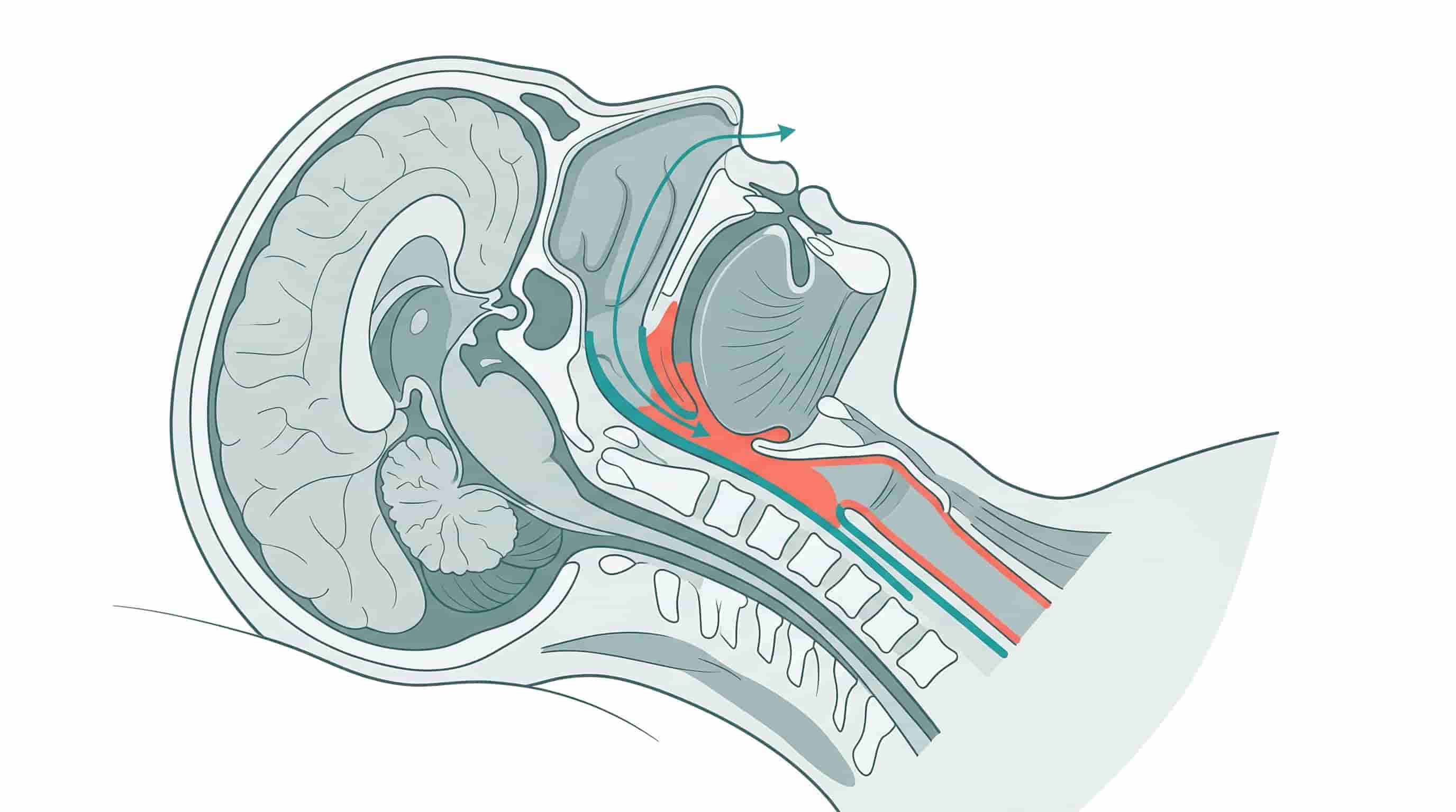 Diagram showing a blocked airway in obstructive sleep apnea