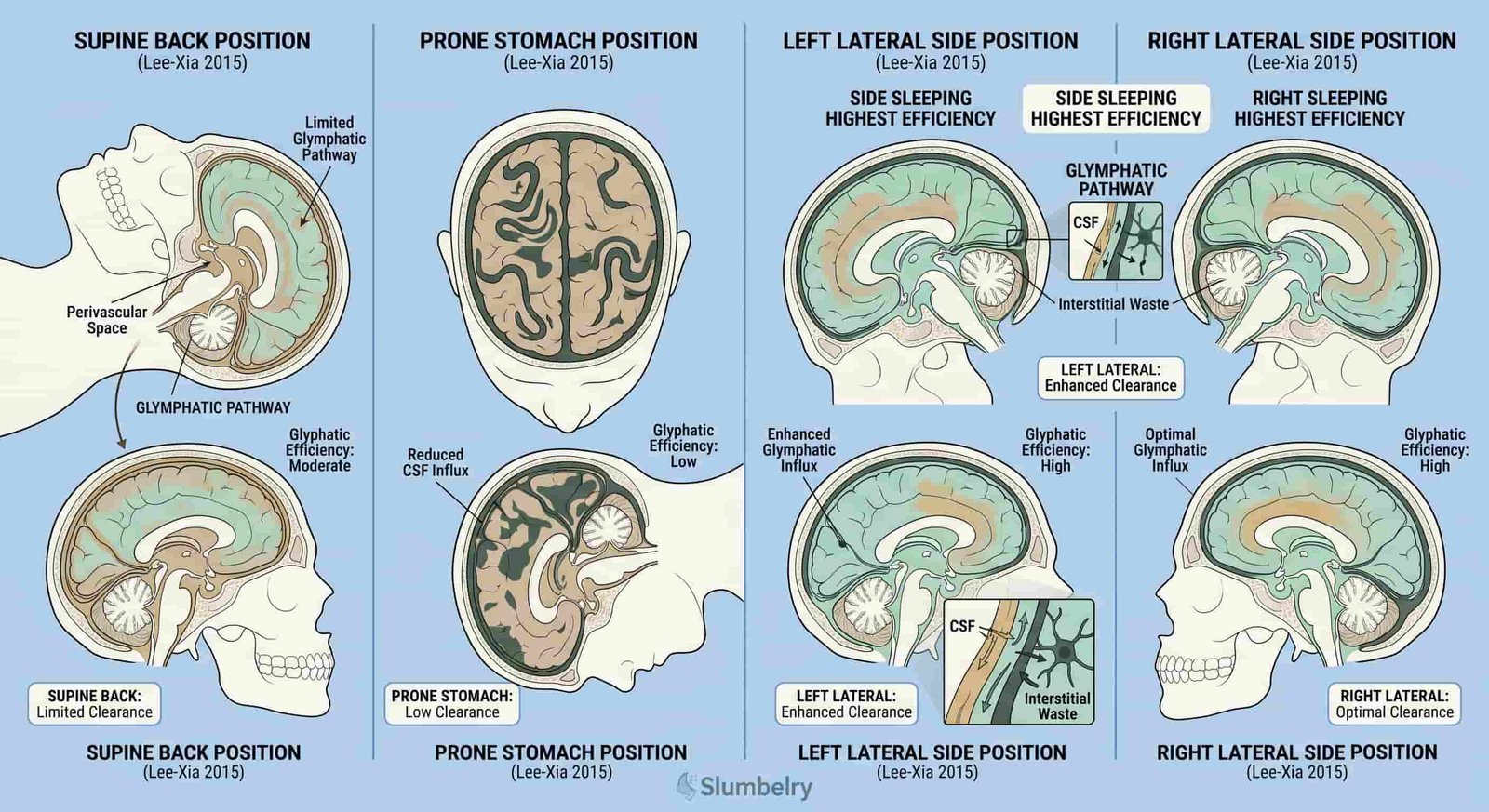 Scientific medical illustration showing glymphatic system efficiency comparison across four sleep positions: supine back, prone stomach, left lateral side, right lateral side positions with arrows showing cerebrospinal fluid CSF flow patterns and glymphatic waste clearance efficiency heat map overlay on each position, annotated diagram with Lee-Xia 2015 findings, showing side sleeping highest efficiency, clean white medical illustration style